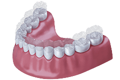 Kieferorthopaedie-Invisalign_240x160.png