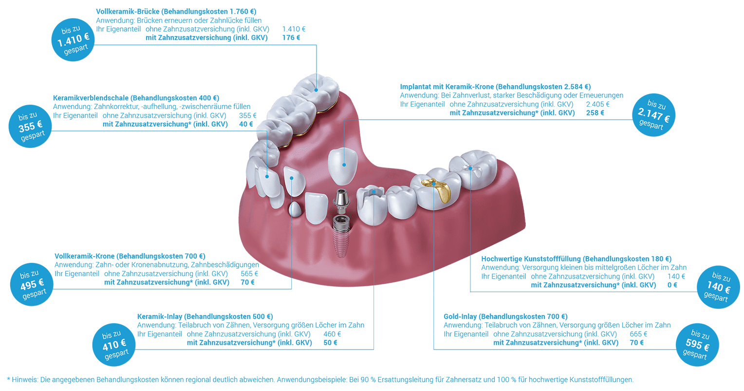 erstattungsbeispiele-zahnersatz-beispiel-90-1528x803.png erstattungsbeispiele-zahnersatz-beispiel-90-1528x803.png