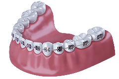 Kieferorthopaedie-Zahnspange-fest_240x160.png