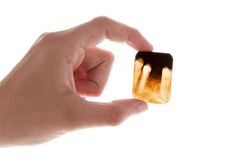 Zahnzusatzversicherung - Mitversicherung fehlender Zähne