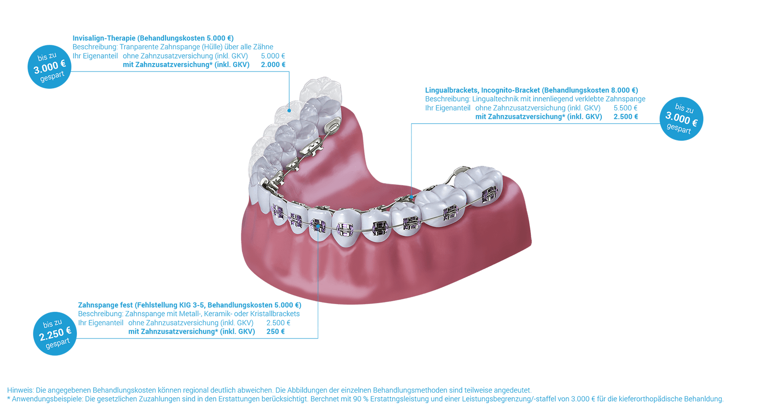 erstattungsbeispiele-Zahnzusatzversicherung-Kieferorthopädie.png