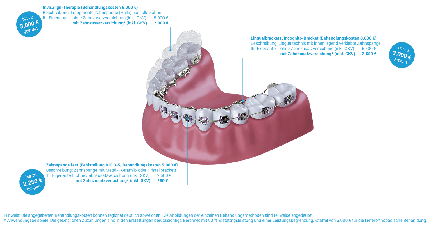 erstattungsbeispiele-Zahnzusatzversicherung-Kieferorthopädie-1476x780.png