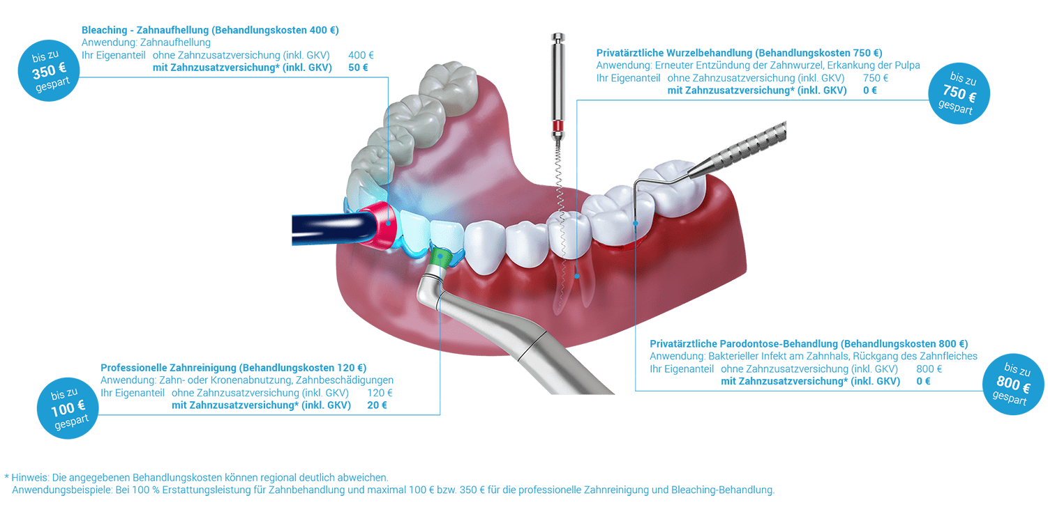 erstattungsbeispiele-zahnbehandlung-beispiel-100-1502x725.png erstattungsbeispiele-zahnbehandlung-beispiel-100-1502x725.png