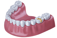Goldinlay